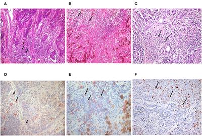 Tumor-Associated Disialylated Glycosphingolipid Antigen-Revealing Antibodies Found in Melanoma Patients' Immunoglobulin Repertoire Suggest a Two-Direction Regulation Mechanism Between Immune B Cells and the Tumor